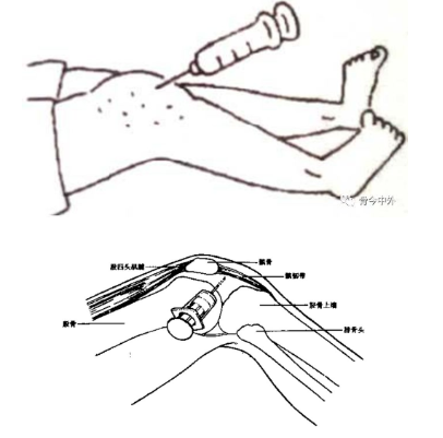 膝关节腔注射的定位图图片