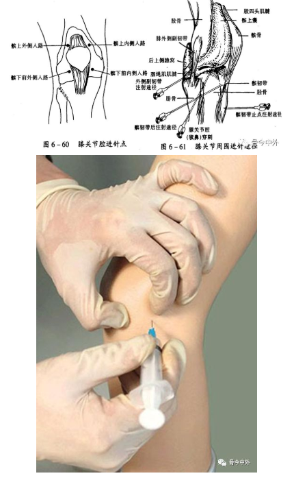 膝关节腔注射的定位图图片