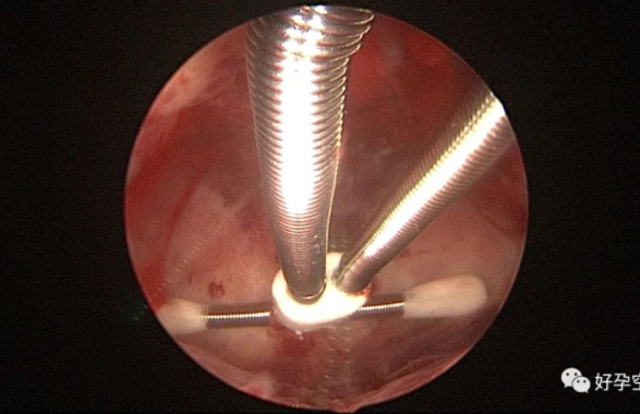 宫腔镜取环手术过程图图片